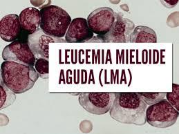 sintomas de leucemia mieloide aguda